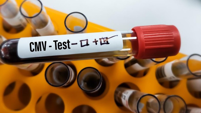 Infeksi Virus CMV dan Dampaknya pada Gejala Autisme pada Anak
