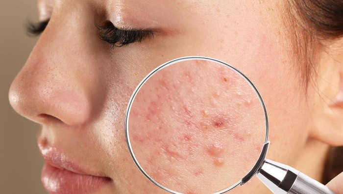 **Dokter Harvard Ungkap Bentuk Jerawat Seperti Ini Bisa Jadi Tanda Kanker Kulit**